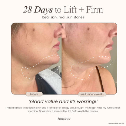 MesoLift | Mesotherapy Wonder Wand