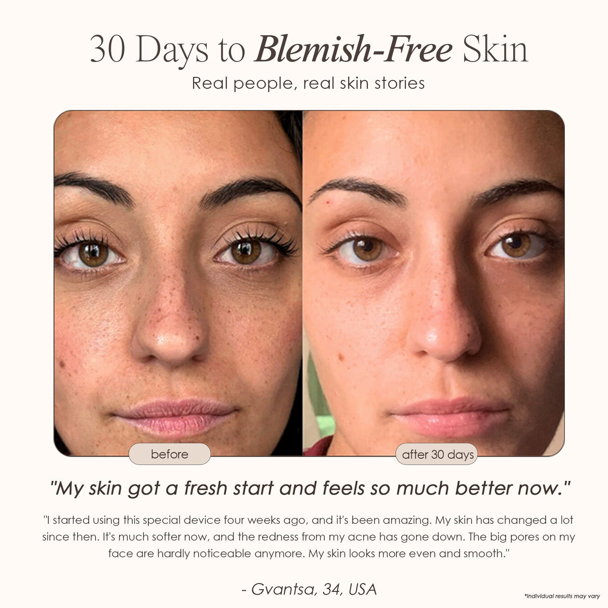 Reinvo | Facial Microdermabrasion Wand