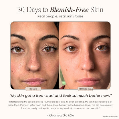 Reinvo | Facial Microdermabrasion Wand
